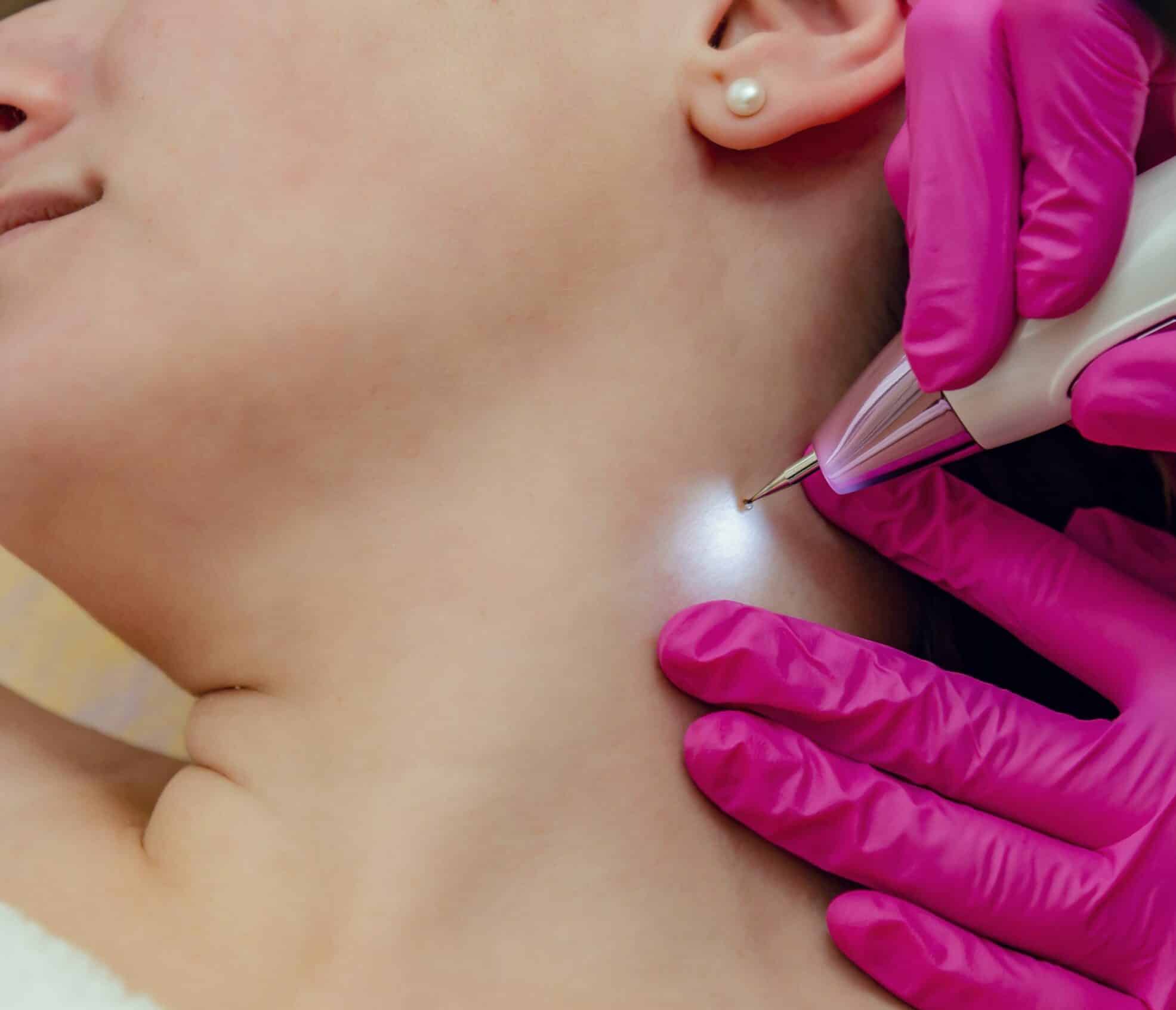 skin tag removal by Fluid Hydration & Wellness